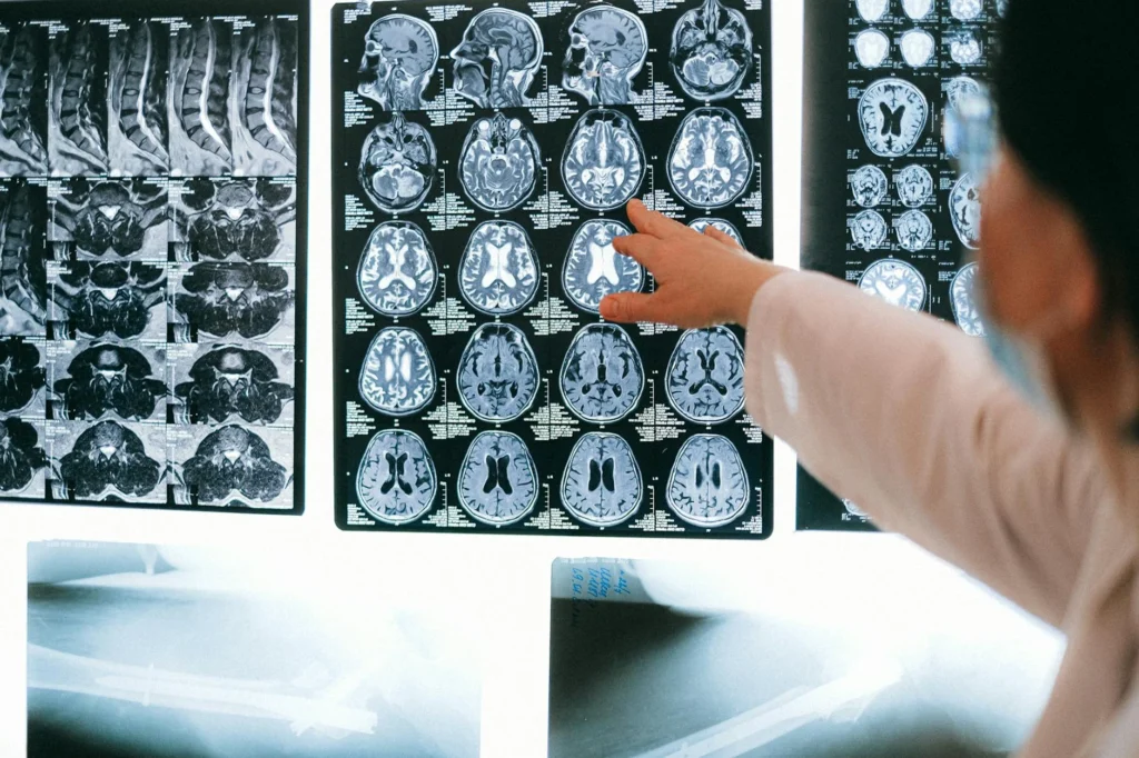 MSA (Çoklu Sistem Atrofisi) Nedir?