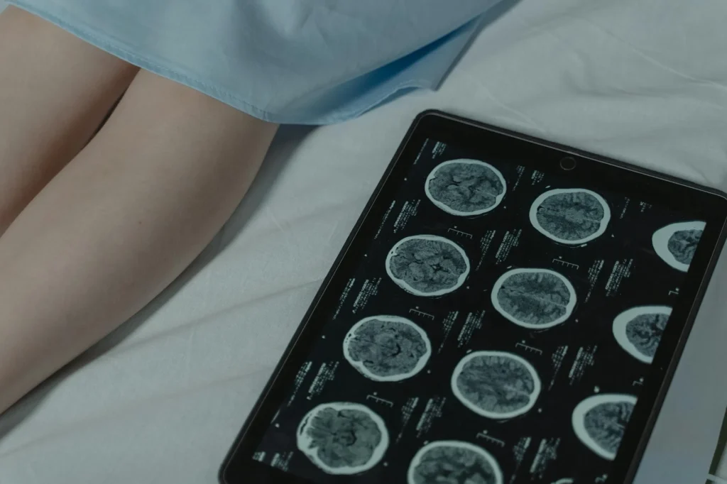 Glial Tümör Nedir?