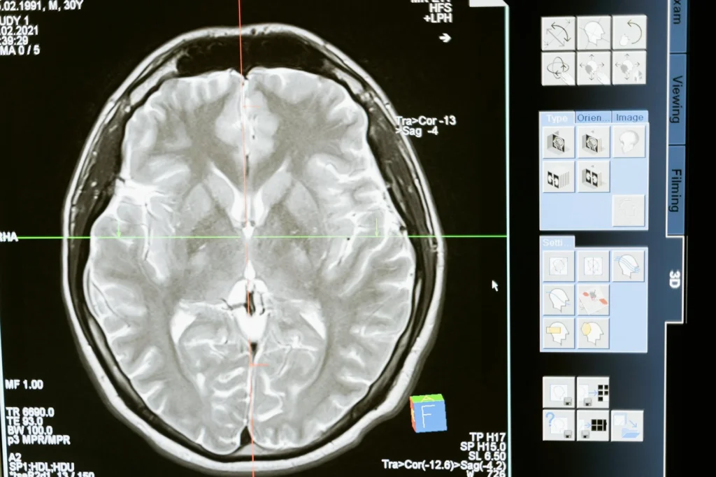 Glial Tümör Nedir?