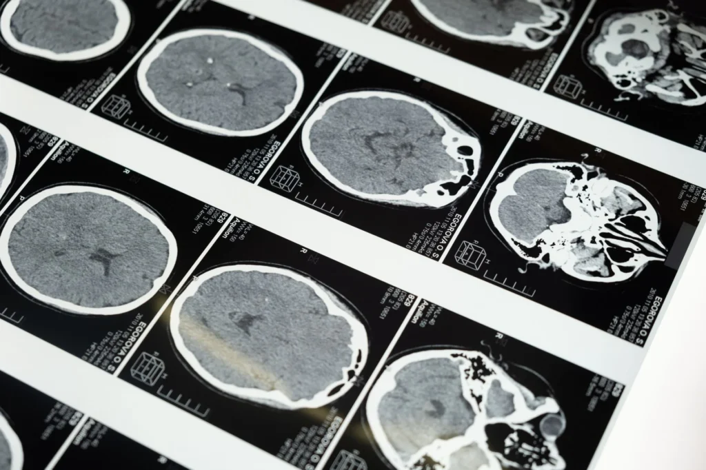 Frontotemporal Demans (FTD) Hastalığı Nedir?