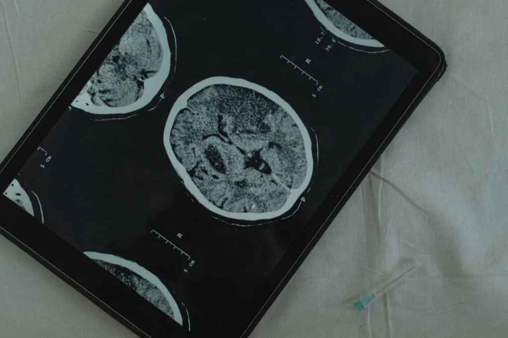 Frontotemporal Demans (FTD) Hastalığı Nedir?