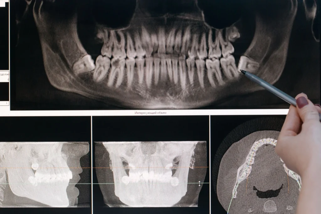 Pense Kemiği" Olarak Bilinen Alt Çene Kemiği (Mandibula) Nedir?